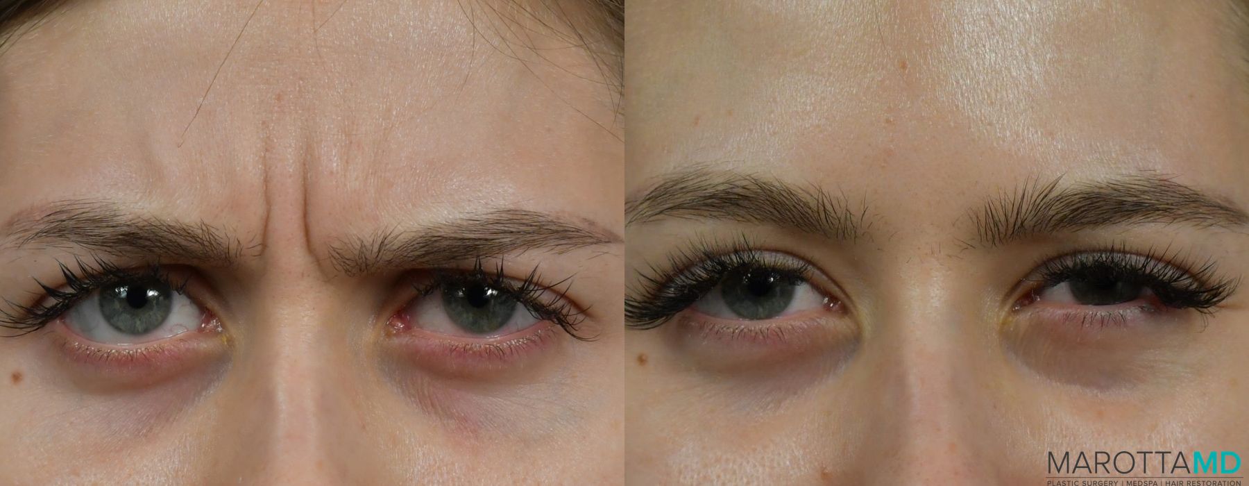 Before and after Botox - Glabella case 7166