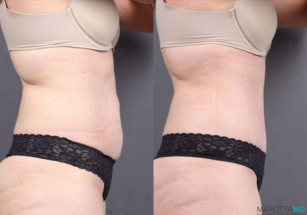 Abdominoplasty - Thumbnail 3