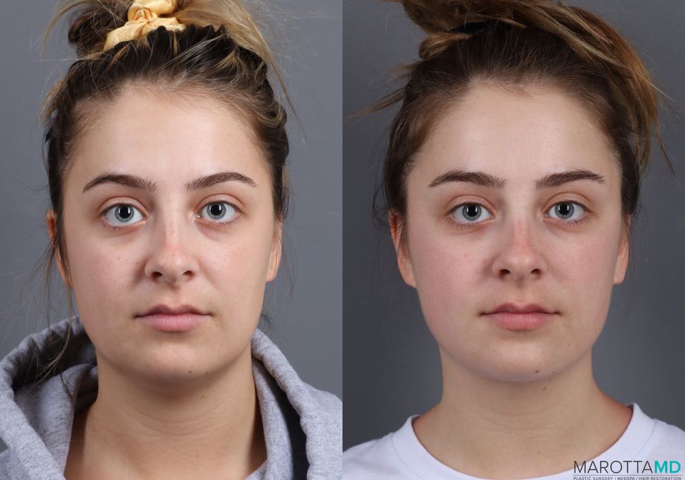 Renuvion - Thumbnail 3