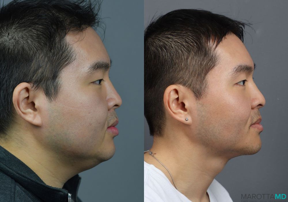 Liposuction of the Neck - Case 230
