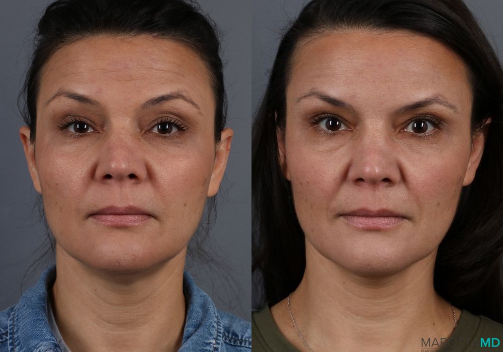 Before and after Botox - Crow's Feet case 7158