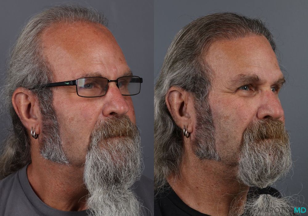 Hair Transplantation - Thumbnail 3