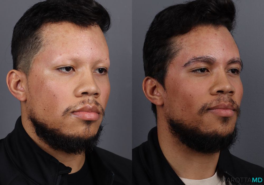 Hair Transplantation - Case 648