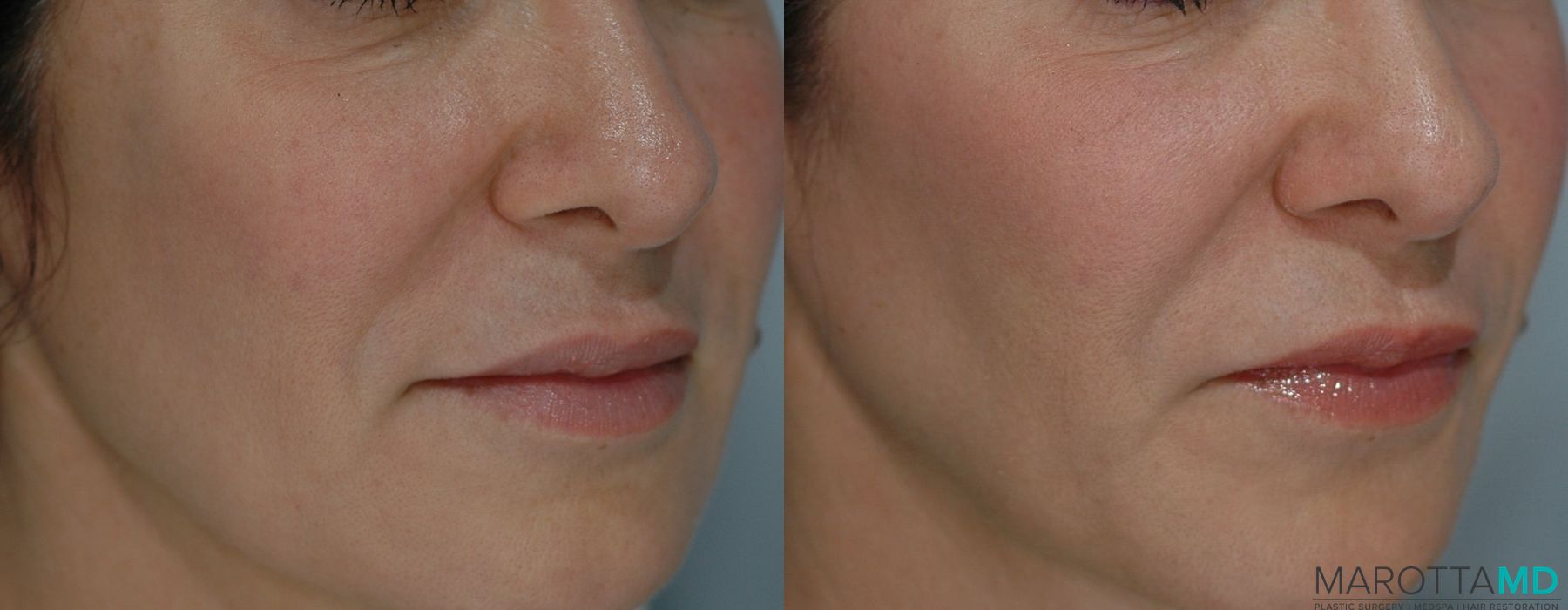 Ultherapy® - Thumbnail 2