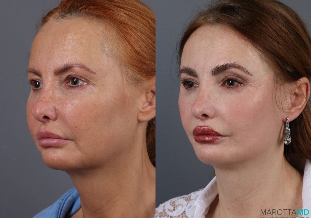 Mini Facelift - Thumbnail 4