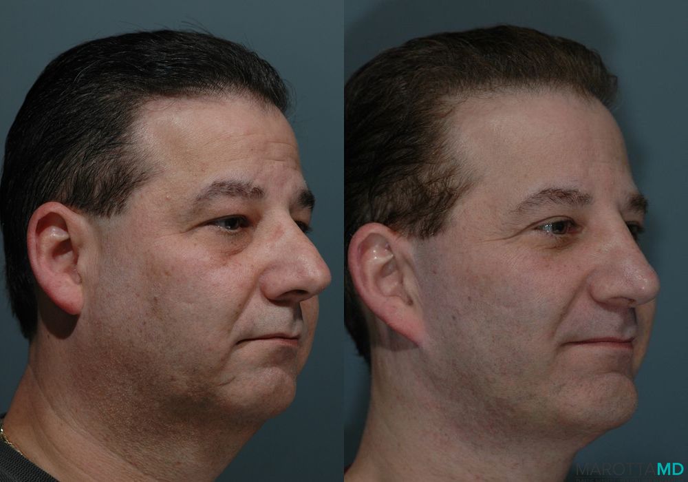 Chin Implant - Case 179