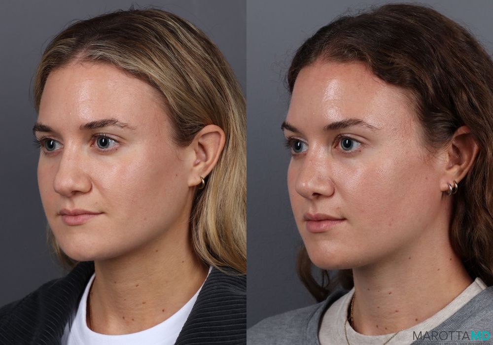 Rhinoplasty - Thumbnail 4