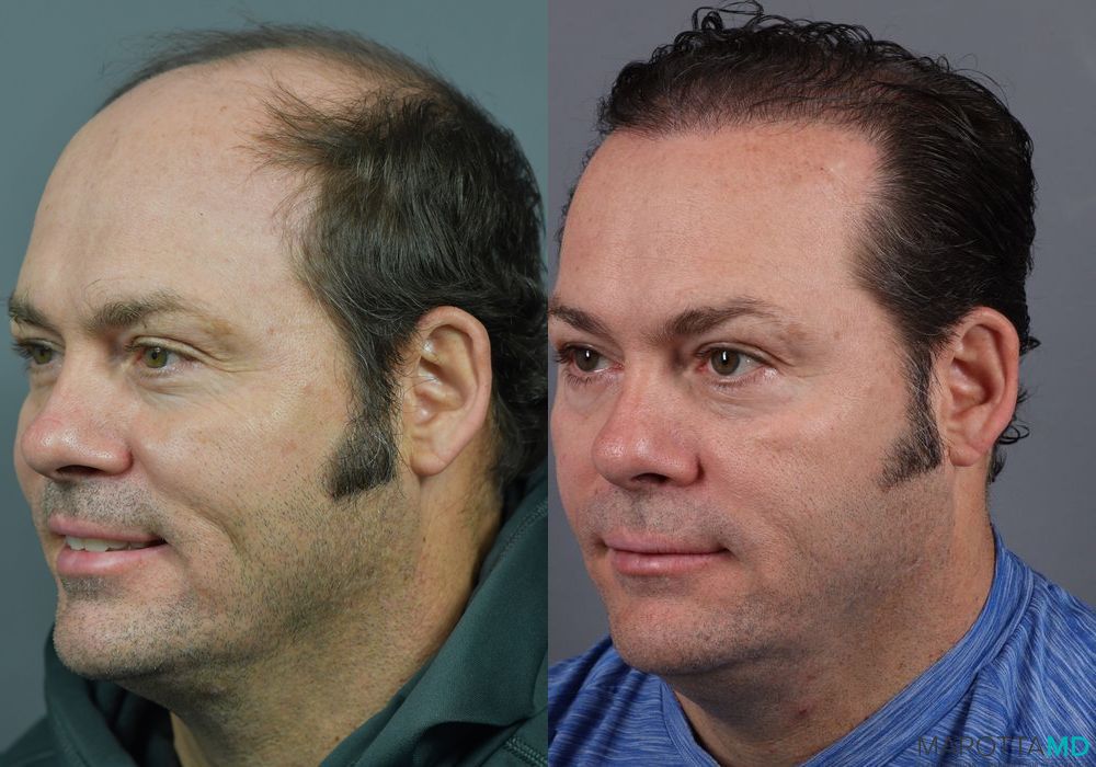 Hair Transplantation - Thumbnail 4