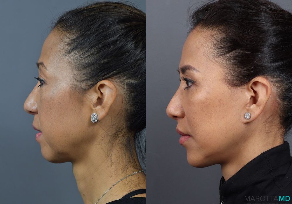 Chin Implant - Thumbnail 5