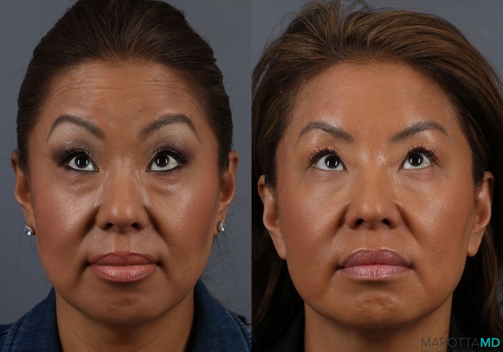 Botox - Glabella - Case 334