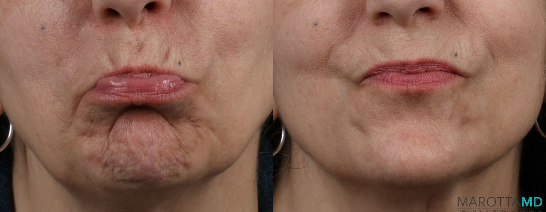 Before and after Botox - Crow's Feet case 7150 - Angle 4