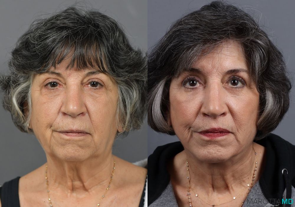 Before and after Chin Implant case 7027