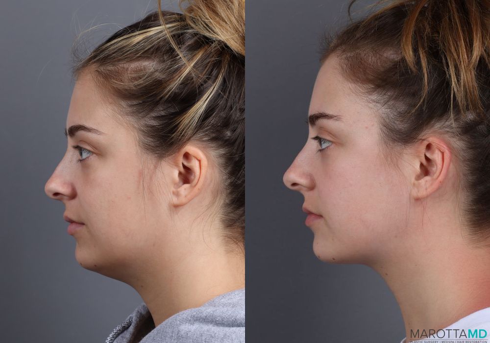 Liposuction of the Neck - Case 231