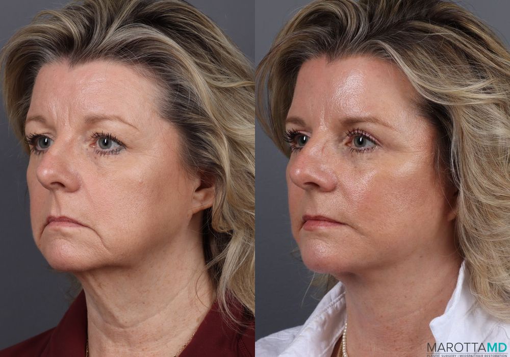 Before and after Facelift & Neck Lift case 7056 - Angle 4