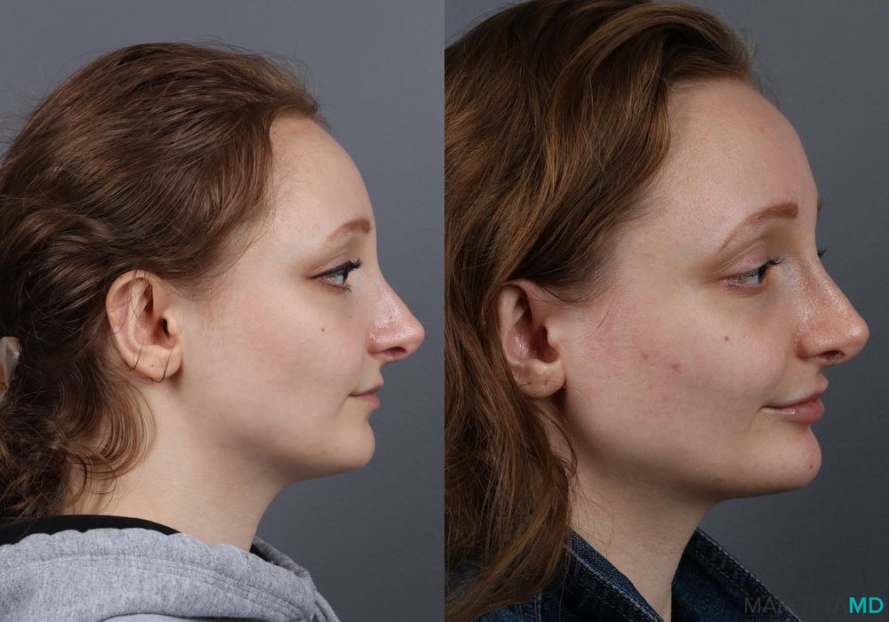 Before and after Fillers case 7141 - Angle 3