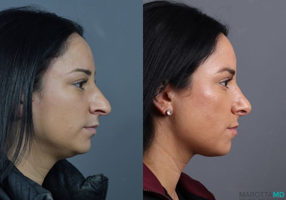 Before and after Rhinoplasty case 7229 - Angle 5