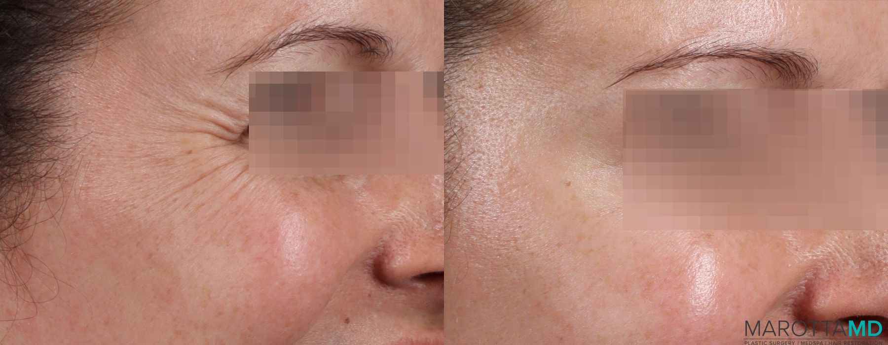 Before and after Botox - Crow's Feet case 7190 - Angle 3
