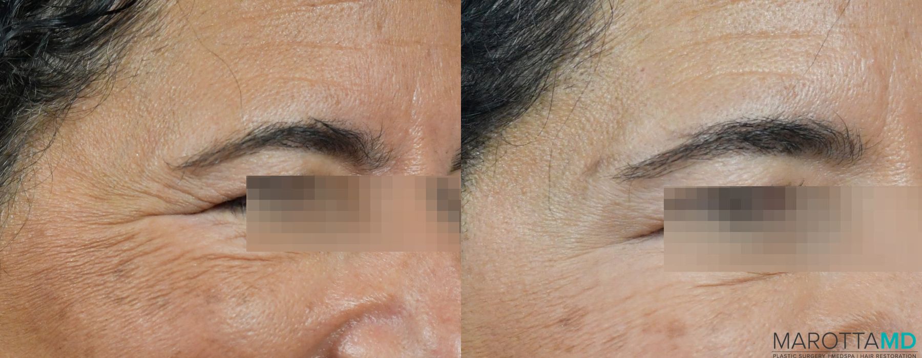 Before and after BOTOX® Cosmetic case 7258 - Angle 2