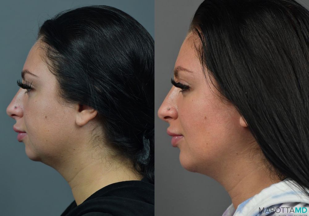 Buccal Fat Removal - Thumbnail 2