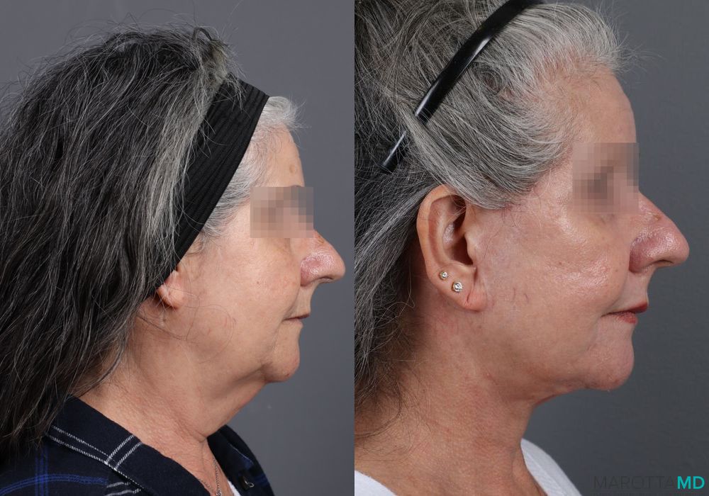 Laser Skin Resurfacing - Face - Thumbnail 4