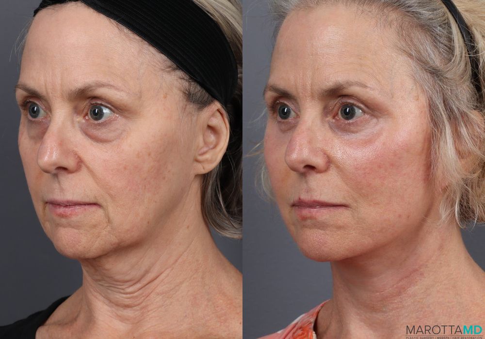 Before and after Facelift & Neck Lift case 7087 - Angle 2