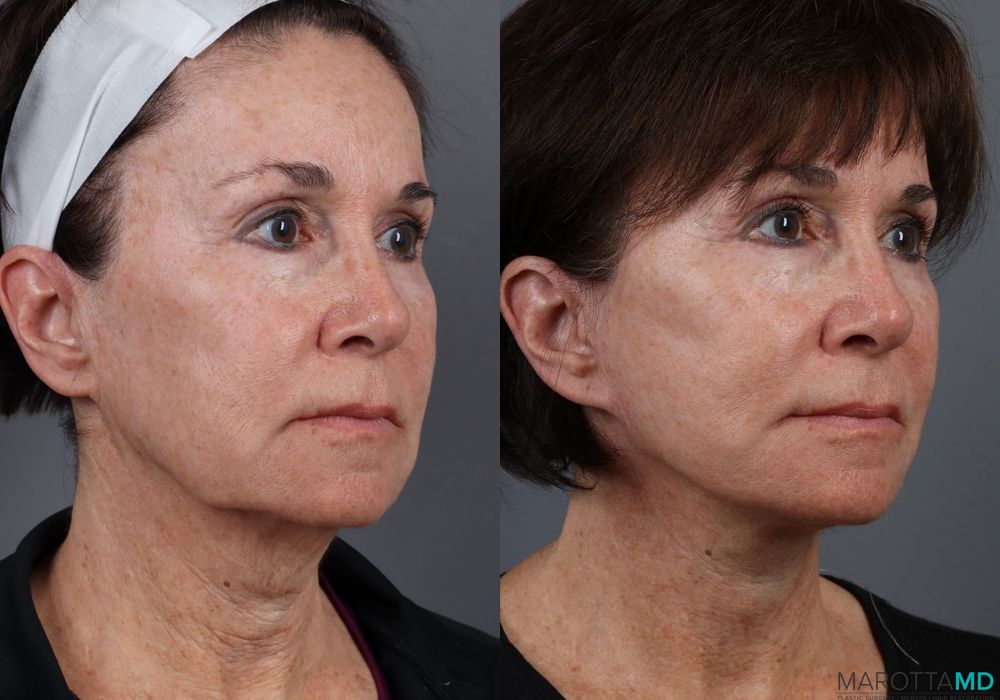 Facelift & Neck Lift - Thumbnail 2