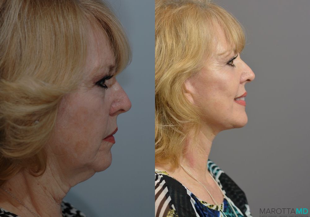 Laser Skin Resurfacing - Face - Thumbnail 4