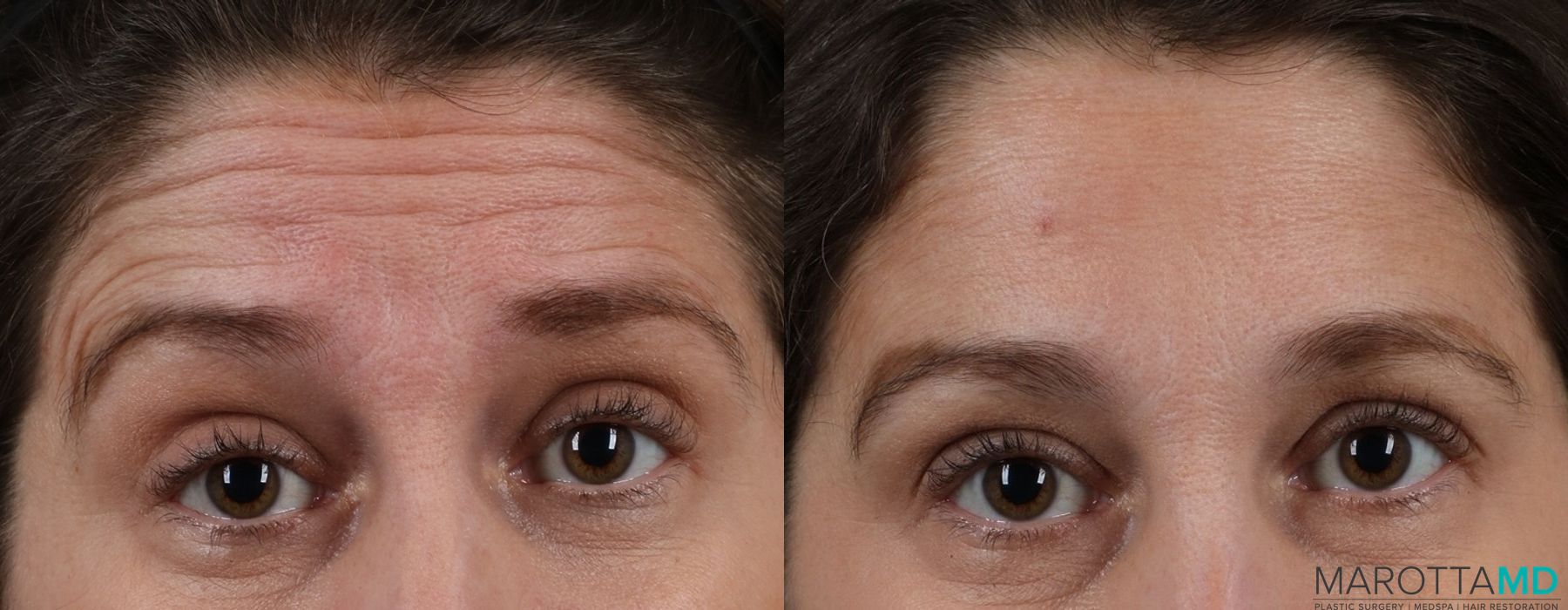 Before and after Botox - Forehead case 7165 - Angle 2