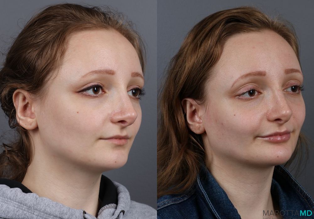 Before and after Fillers case 7141 - Angle 2