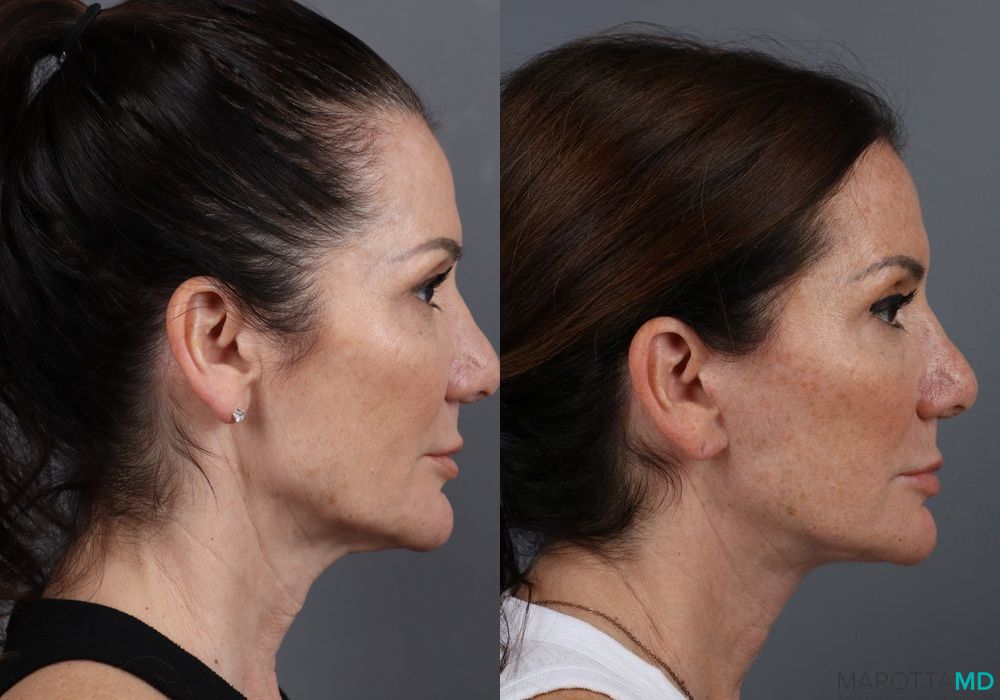 Facelift & Neck Lift - Thumbnail 2