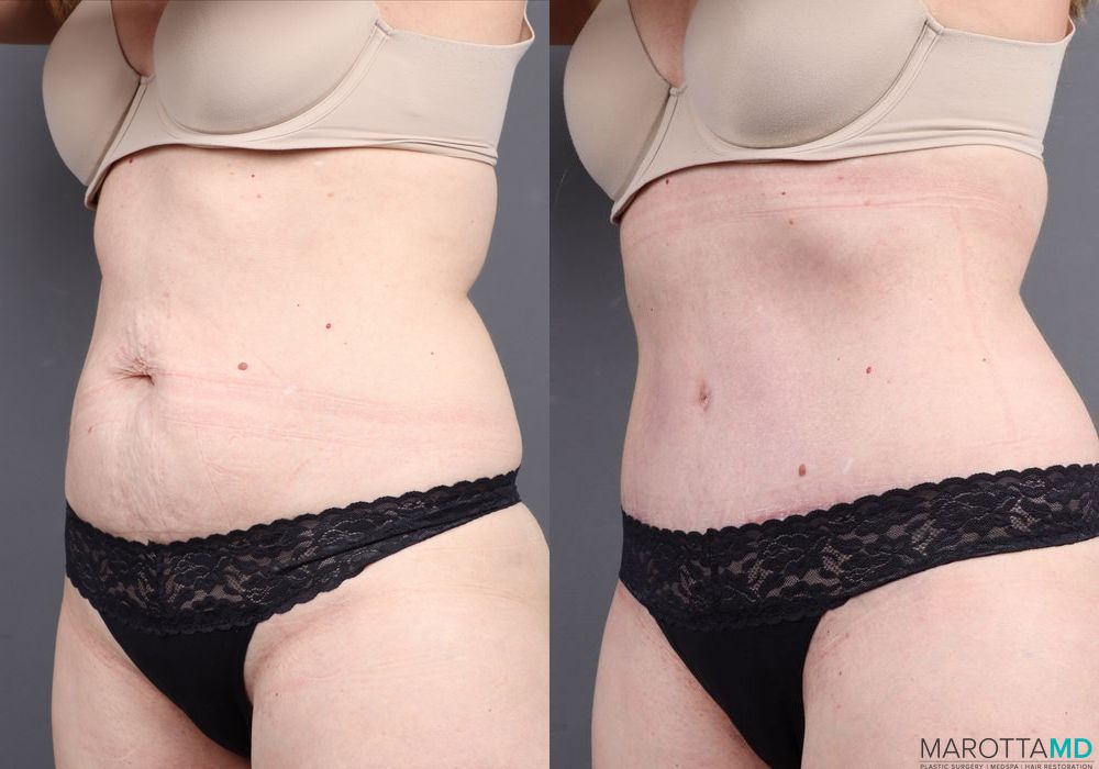 Abdominoplasty - Thumbnail 5