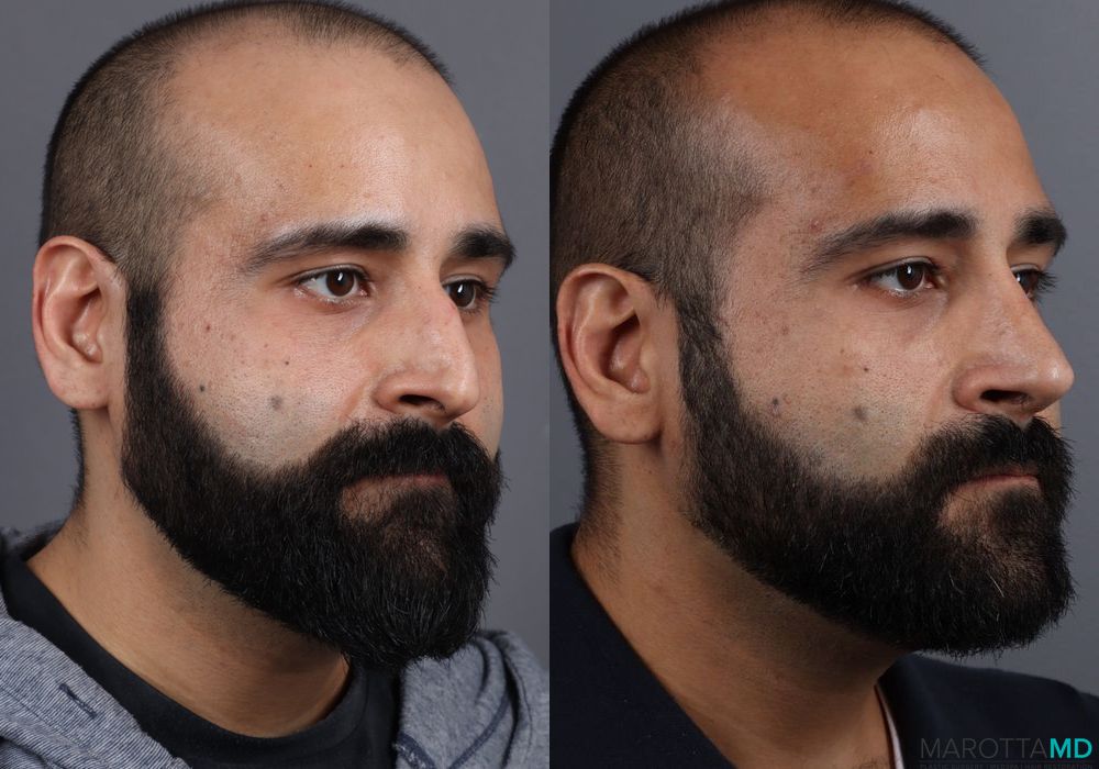 Before and after Male Rhinopolasty case 7261 - Angle 5