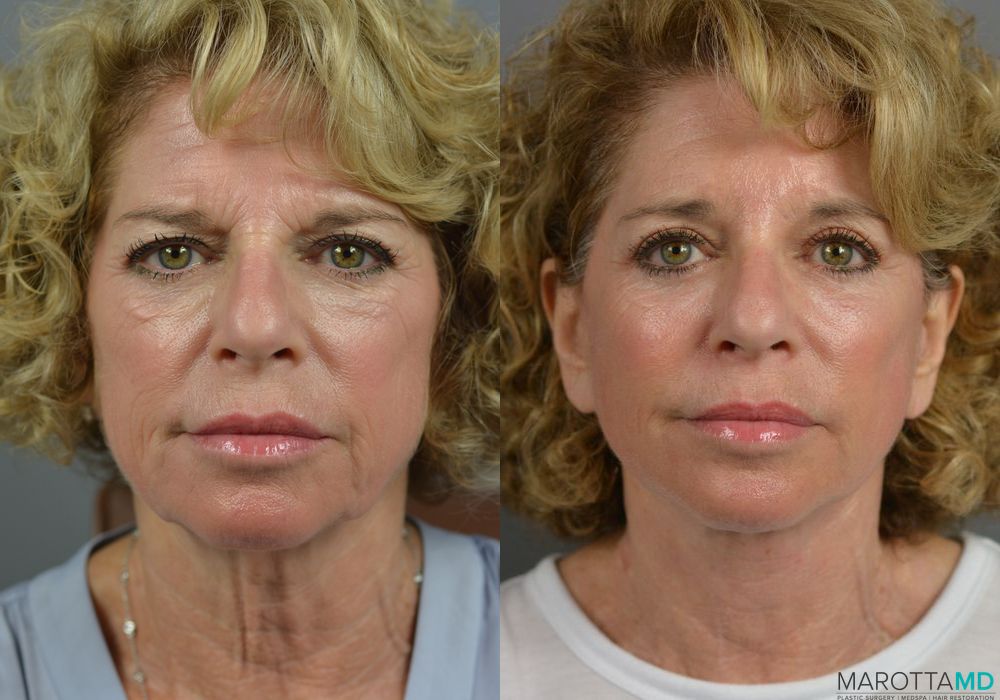 Endoscopic Brow Lift - Thumbnail 3