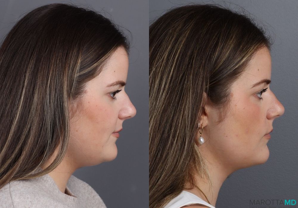 Before and after Skin Tightening Face case 7265 - Angle 3