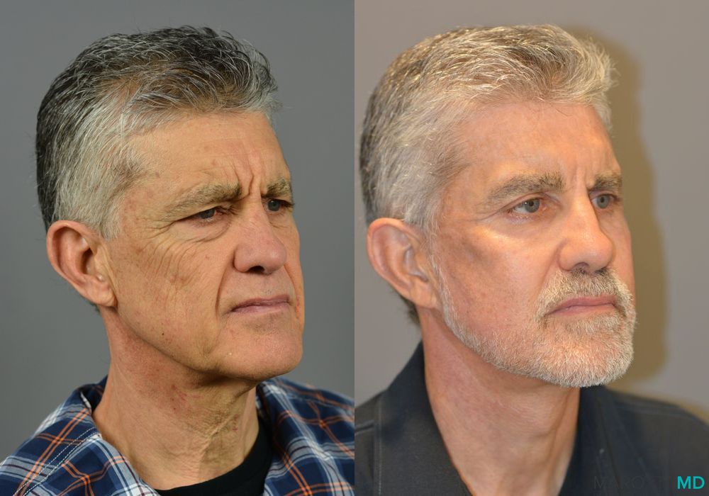 Facelift & Neck Lift - Thumbnail 3