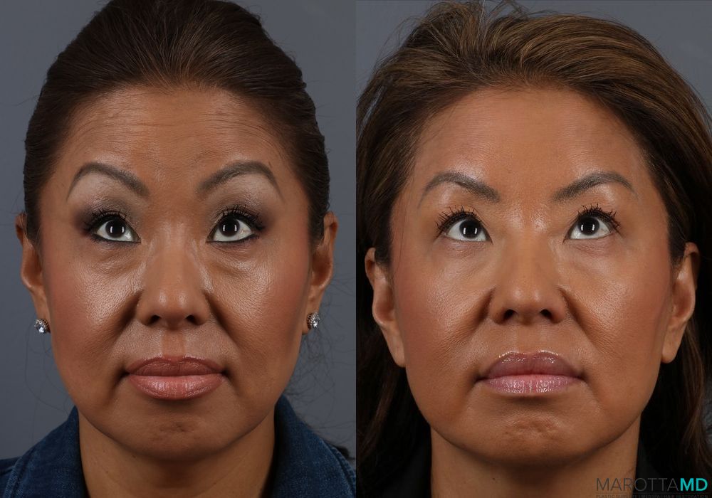 BOTOX® Cosmetic - Thumbnail 4