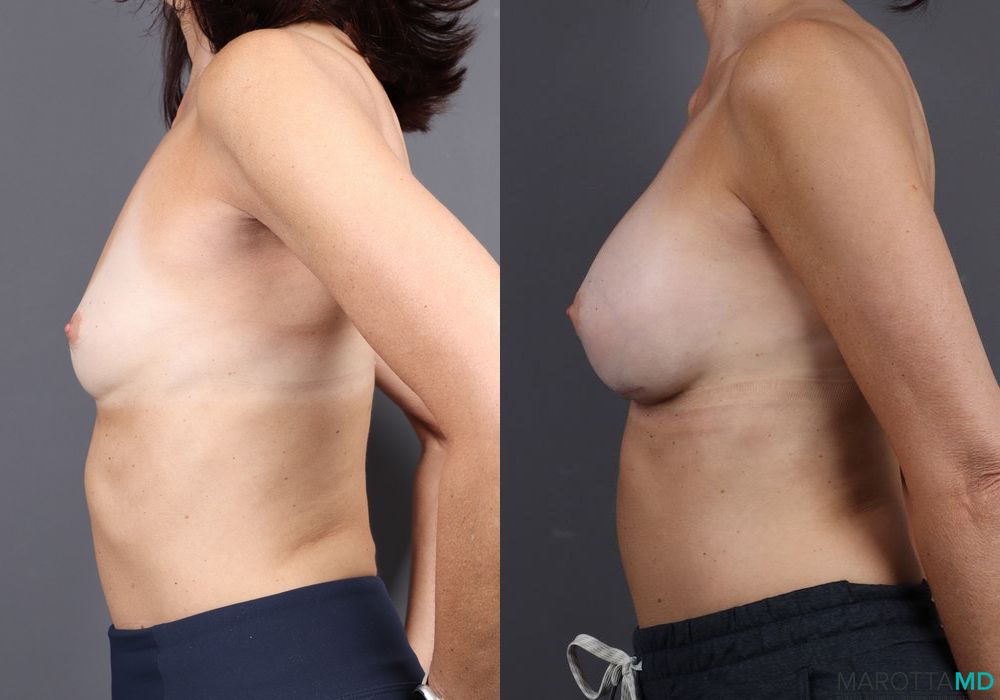 Breast Augmentation - Thumbnail 4