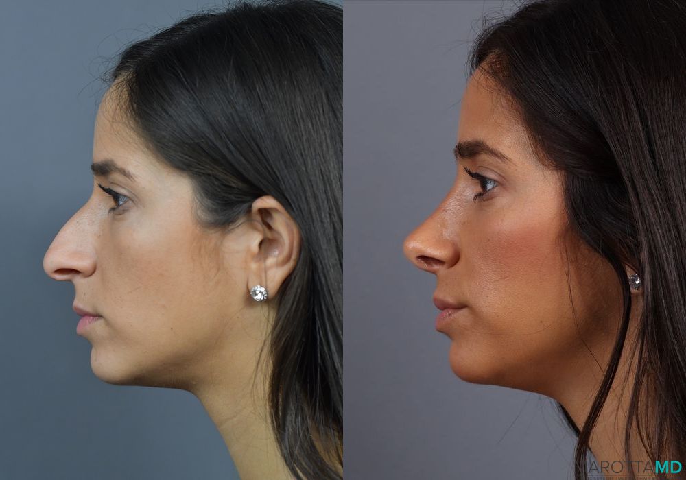 Before and after Rhinoplasty case 7278 - Angle 3