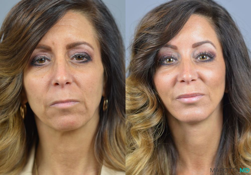 Facelift/Mini Facelift - Case 1013