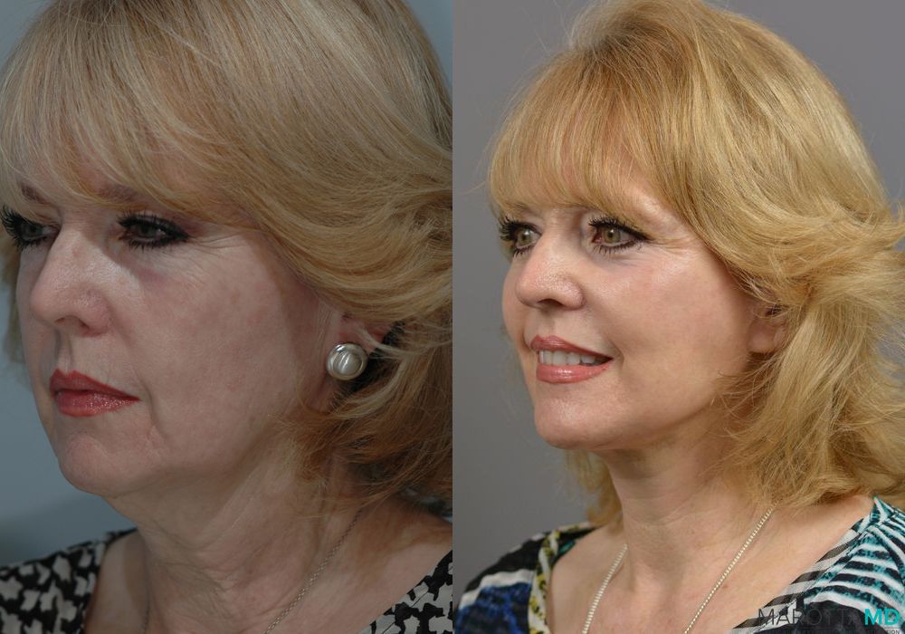 Laser Skin Resurfacing - Face - Thumbnail 2