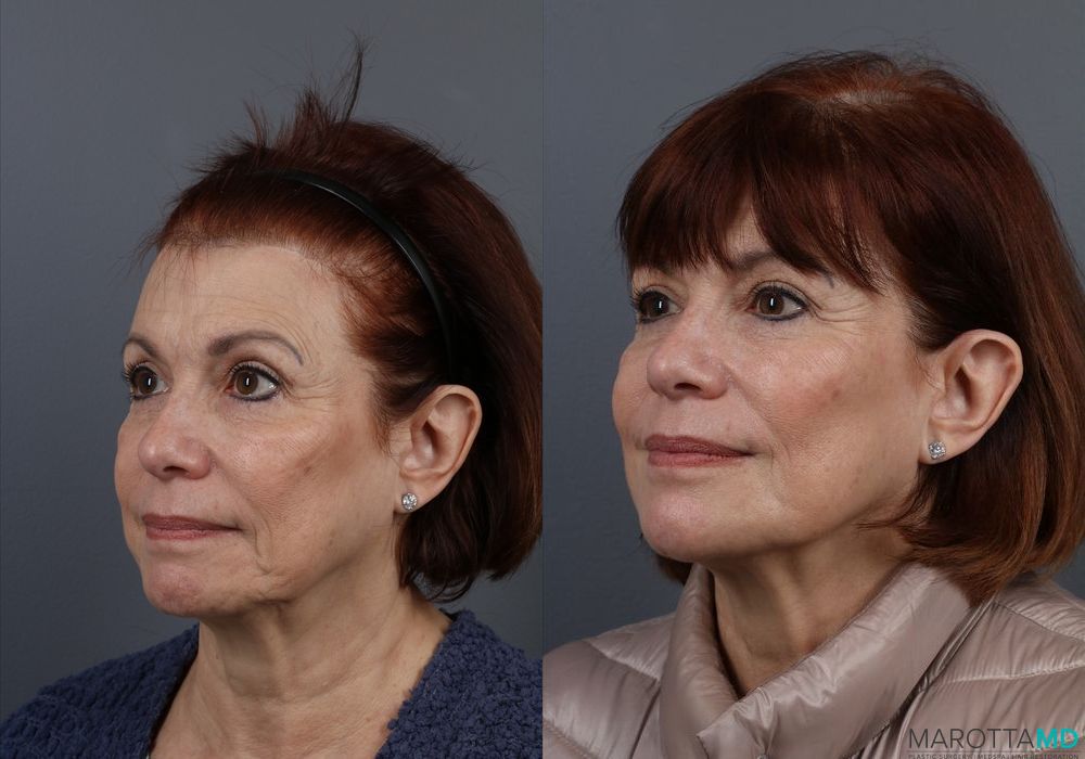 Botox - DAO - Thumbnail 4