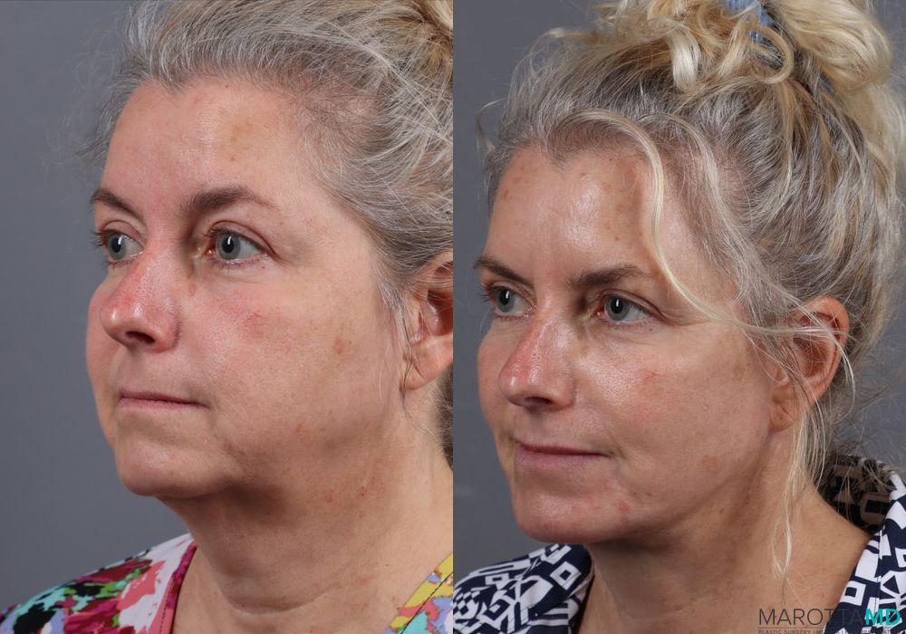 Facelift & Neck Lift - Thumbnail 2