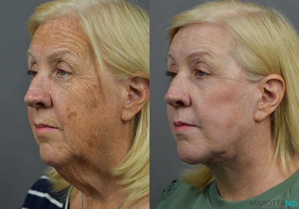 Laser Skin Resurfacing - Face - Case 215