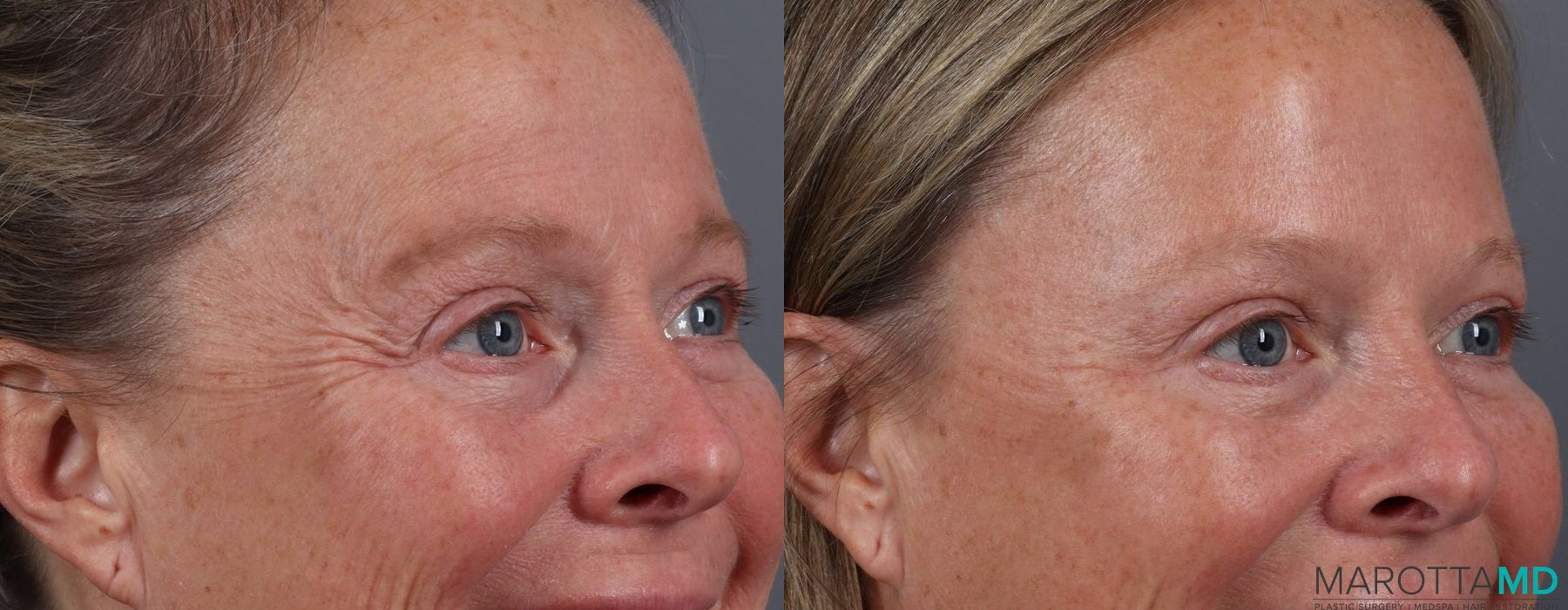 Before and after Botox - Crow's Feet case 7131 - Angle 2