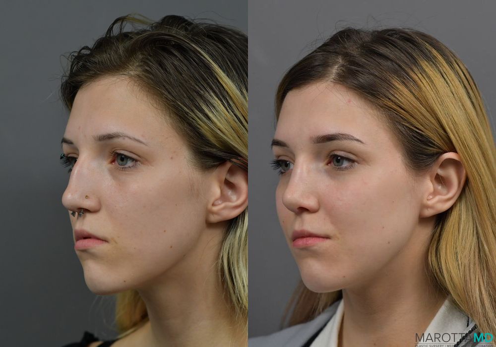 Before and after Rhinoplasty case 7257 - Angle 4
