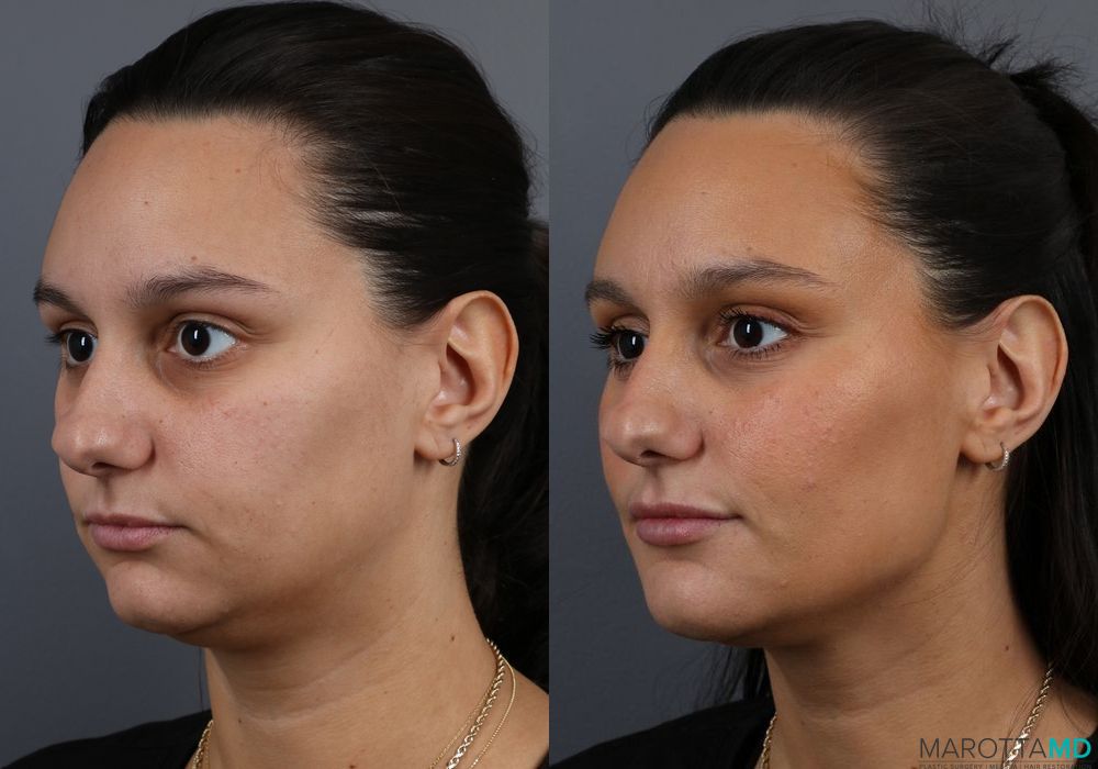 Before and after Filler - Lips case 7210 - Angle 4