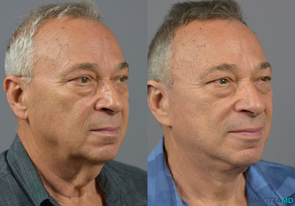 Facelift & Neck Lift - Thumbnail 2