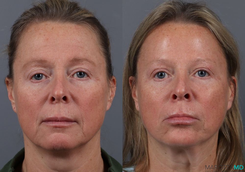 Before and after Botox - DAO case 7132 - Angle 3