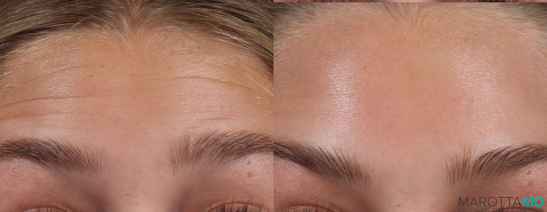 Before and after BOTOX® Cosmetic case 7226