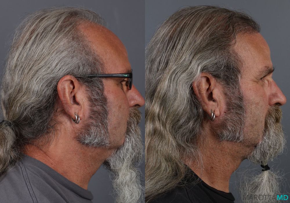 Hair Transplantation - Thumbnail 5